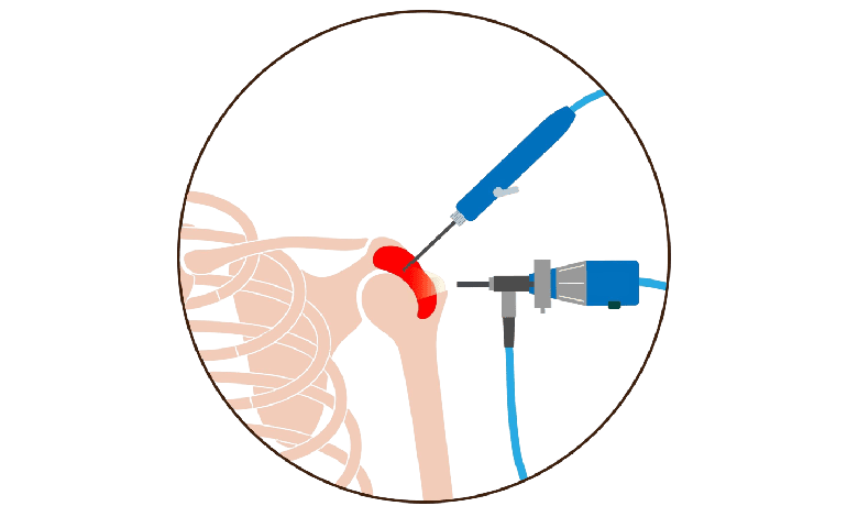 Artroscopia de Rodilla y hombro