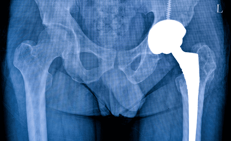 Cirugía de Reemplazo Articular de Rodilla y Cadera