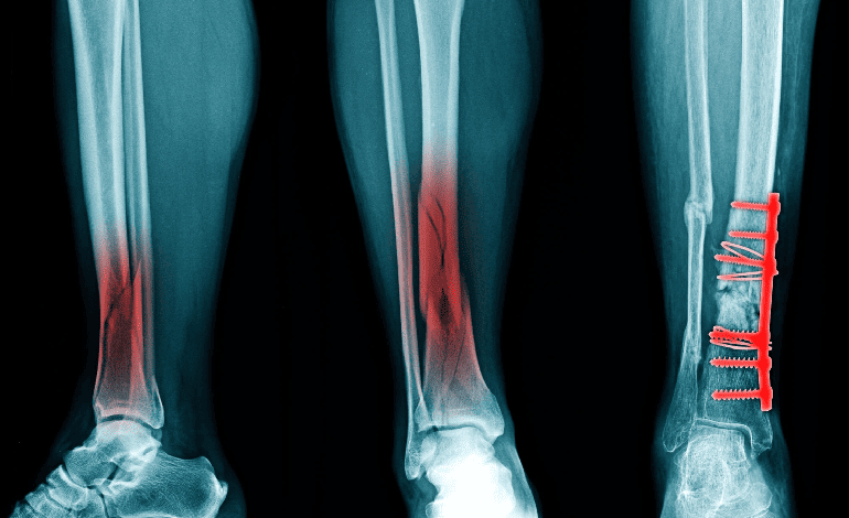 Osteosíntesis de las fracturas